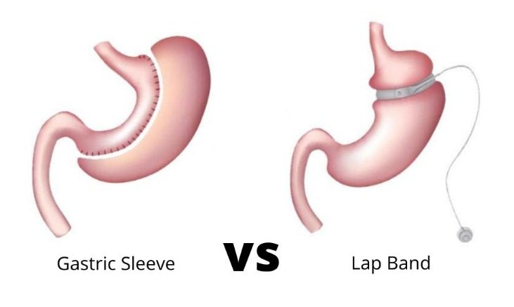 Differences Between Lap-Band & Gastric Sleeve Surgery