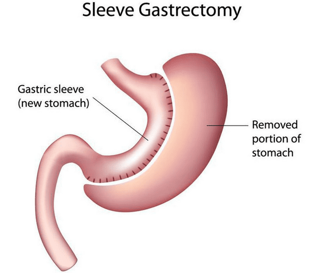 gastric-sleeve 