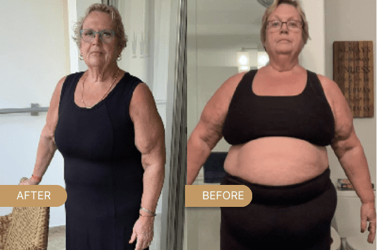 Gastric-sleeve-before-and-after-skin