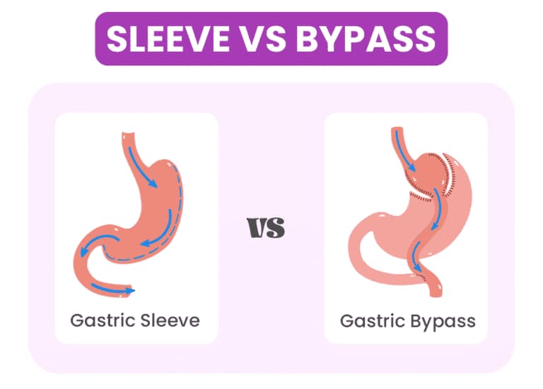 Gastric Sleeve Surgery vs. Gastric Bypass: Which is Right for You?