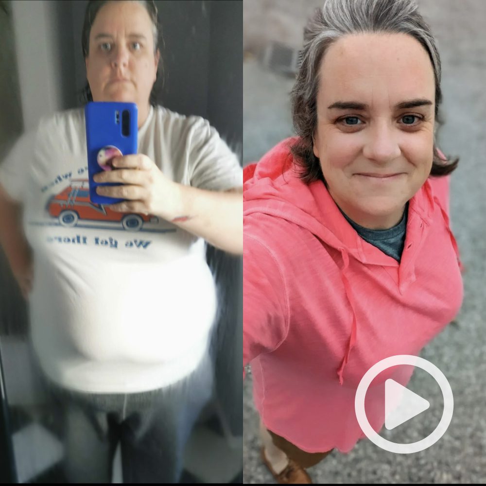 Alex - Lost 118 lbs with gastric sleeve surgery