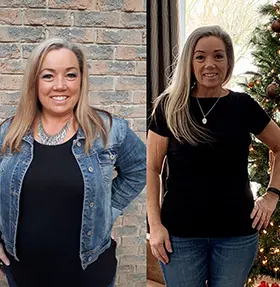 Transformation of Rochelle, a patient at Sleeve Clinic before and after undergoing bariatric surgery.