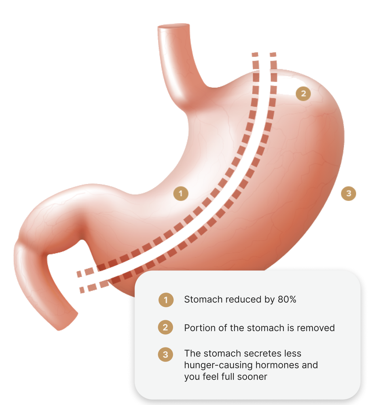 Stomach diagram with labels - Number 1 says "Stomach reduced by 80%", number 2 says "Portion of the stomach is removed", and number 3 says "The stomach secretes less hunger-causing hormones and you feel full sooner".
