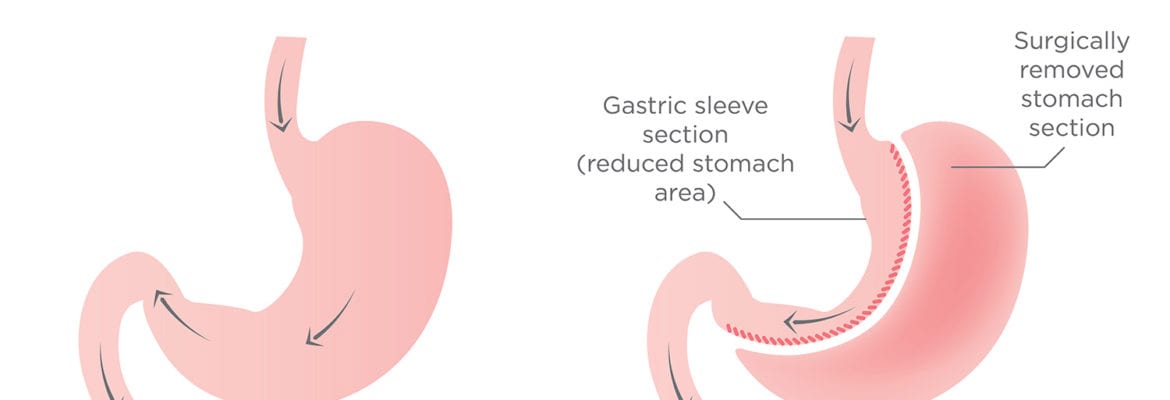what is the gastric sleeve procedure