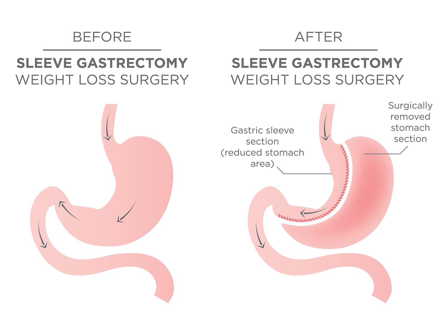 How long does a gastric sleeve last?
