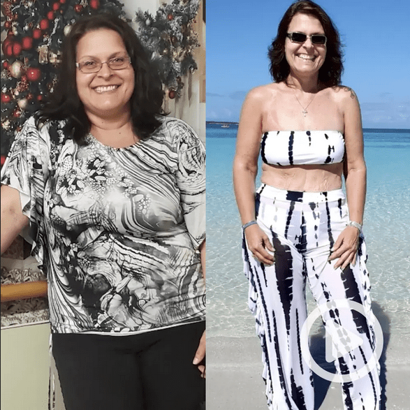 Gastric Sleeve Surgery Recovery Time And Post Op Symptoms 