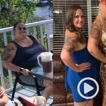 Transformation of Jackie, a patient at Sleeve Clinic before and after undergoing bariatric surgery.