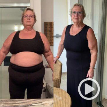 Transformation of Barb, a patient at Sleeve Clinic before and after undergoing bariatric surgery.
