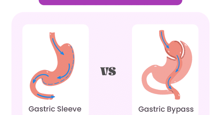 bypass vs gastric sleeve